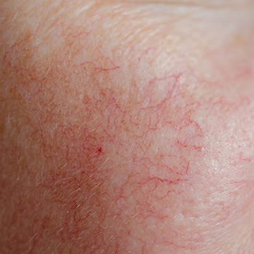rosacea facial trreatment