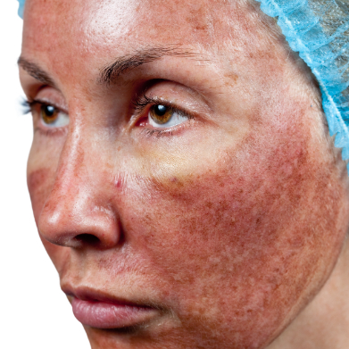 chemical-peel-damage