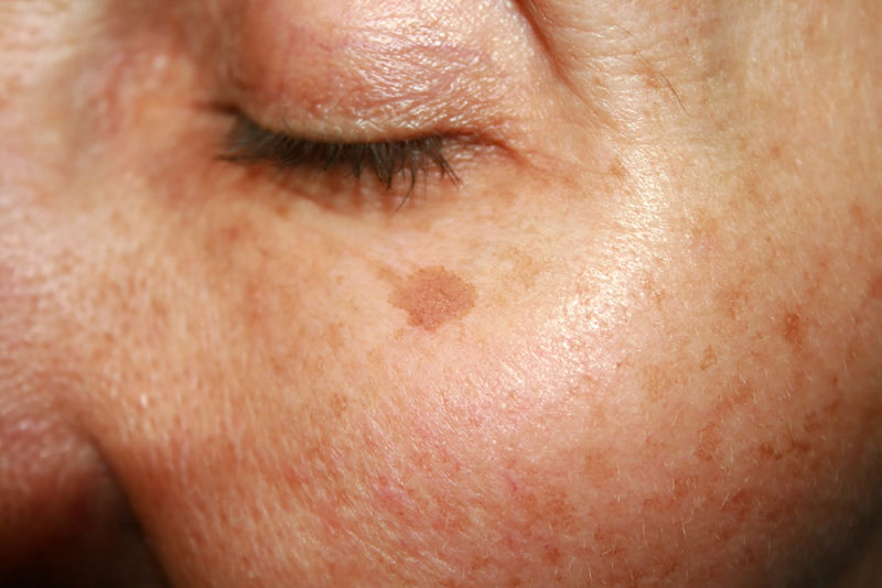 glutathione-brown-spots