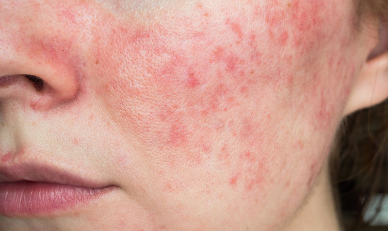 how-does-gut-health-affect-skin-rosacea